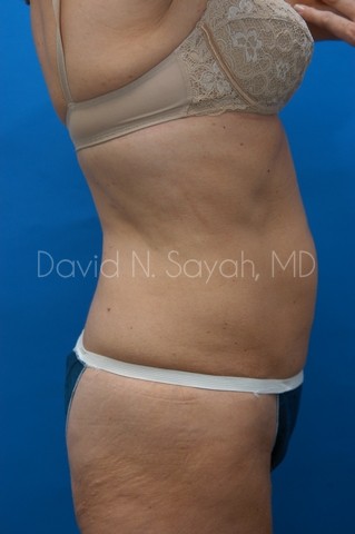 Back Tuck Belt Lipectomy Before and After | Sayah Institute
