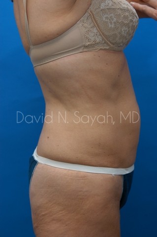 Back Tuck Belt Lipectomy Before and After | Sayah Institute