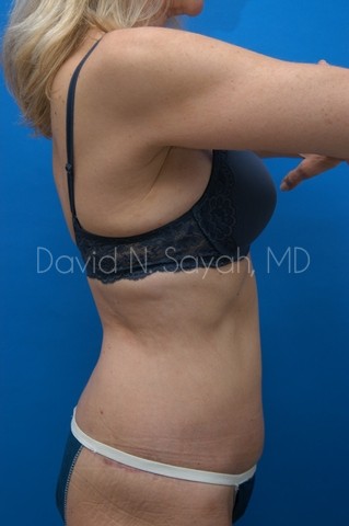 Back Tuck Belt Lipectomy Before and After | Sayah Institute