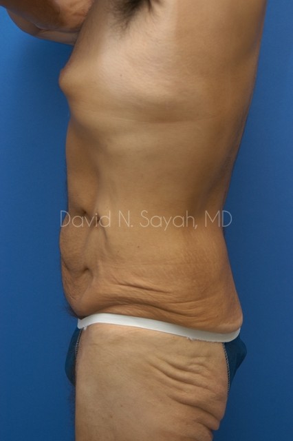 Back Tuck Belt Lipectomy Before and After | Sayah Institute