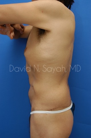 Back Tuck Belt Lipectomy Before and After | Sayah Institute