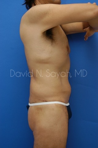 Back Tuck Belt Lipectomy Before and After | Sayah Institute