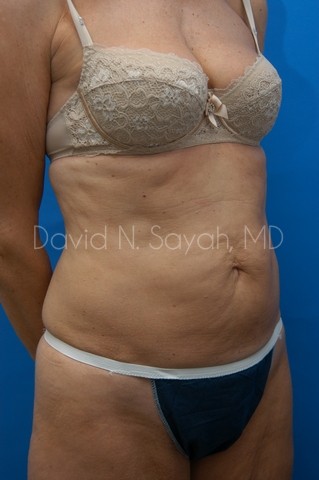 Body Lift Before and After | Sayah Institute