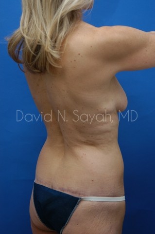 Body Lift Before and After | Sayah Institute
