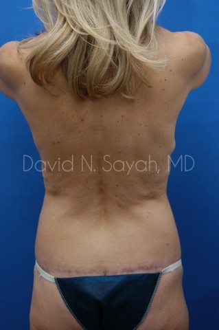 Body Lift Before and After | Sayah Institute