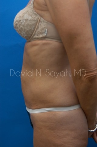Body Lift Before and After | Sayah Institute