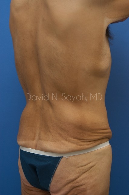 Body Lift Before and After | Sayah Institute