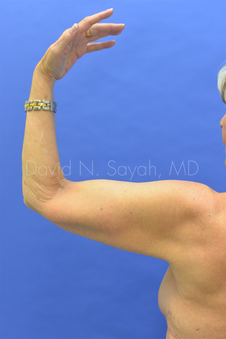 Brachioplasty Before and After | Sayah Institute