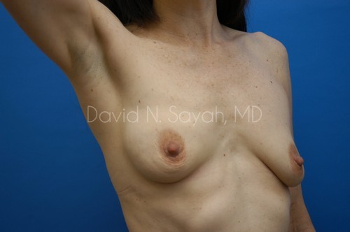 Breast Augmentation And Mastopexy Before and After | Sayah Institute