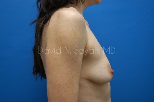 Breast Augmentation And Mastopexy Before and After | Sayah Institute