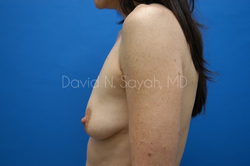 Breast Augmentation And Mastopexy Before and After | Sayah Institute