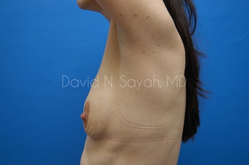 Breast Augmentation And Mastopexy Before and After | Sayah Institute