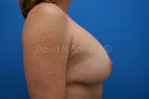 Breast Augmentation And Mastopexy Before and After | Sayah Institute