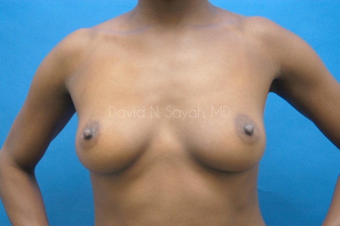 Breast Augmentation Before and After | Sayah Institute