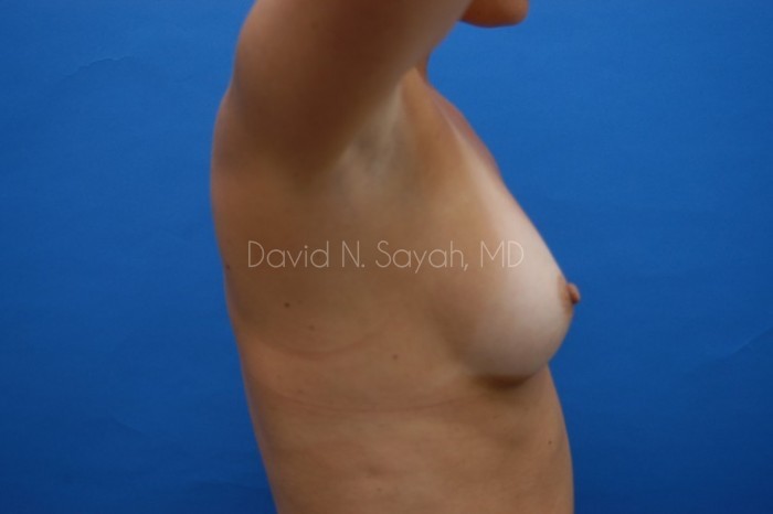 Breast Augmentation Before and After | Sayah Institute