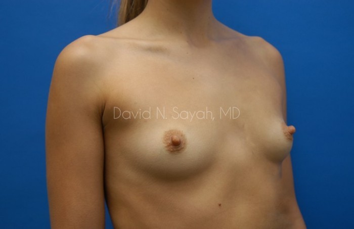 Breast Augmentation Before and After | Sayah Institute