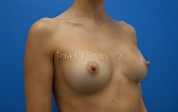 Breast Augmentation Before and After | Sayah Institute