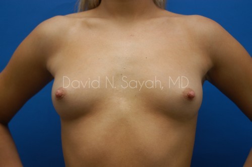 Breast Augmentation Before and After | Sayah Institute