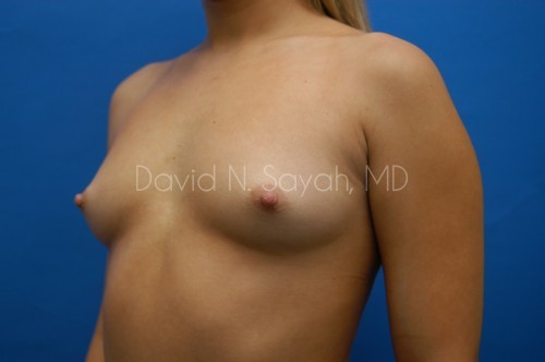 Breast Augmentation Before and After | Sayah Institute