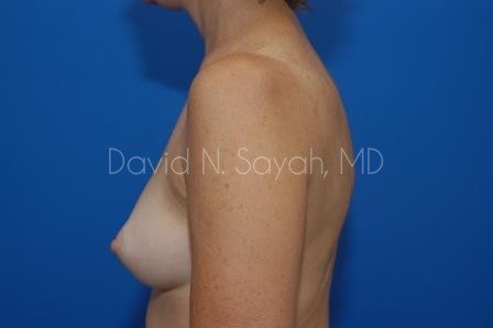 Breast Augmentation Before and After | Sayah Institute