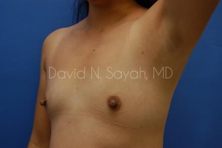 Breast Augmentation Before and After | Sayah Institute