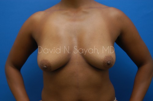 Breast Augmentation Before and After | Sayah Institute