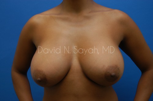 Breast Augmentation Before and After | Sayah Institute