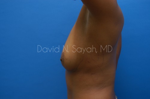 Breast Augmentation Before and After | Sayah Institute