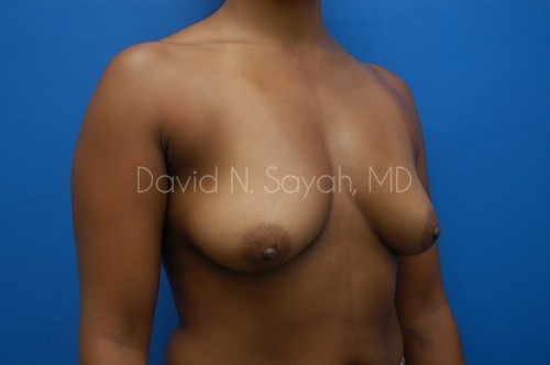 Breast Augmentation Before and After | Sayah Institute