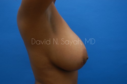 Breast Augmentation Before and After | Sayah Institute