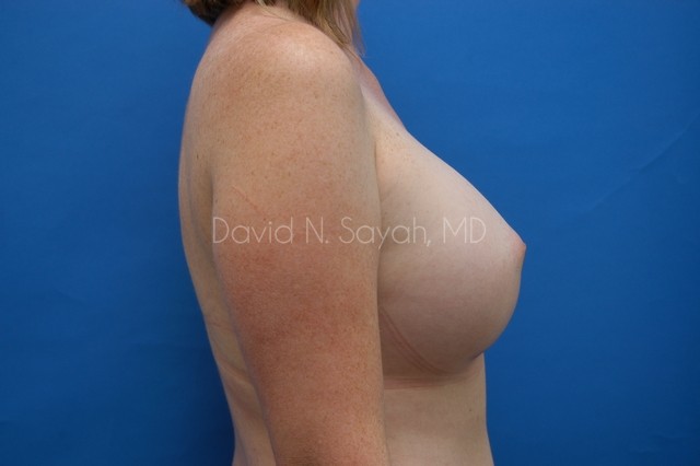 Breast Augmentation Before and After | Sayah Institute