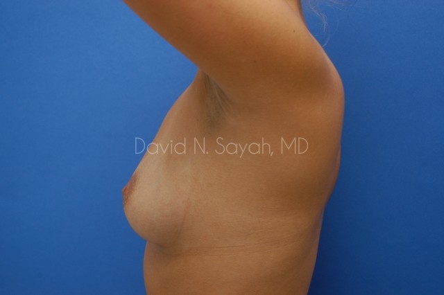 Breast Augmentation Before and After | Sayah Institute