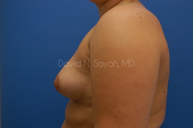 Breast Augmentation Before and After | Sayah Institute