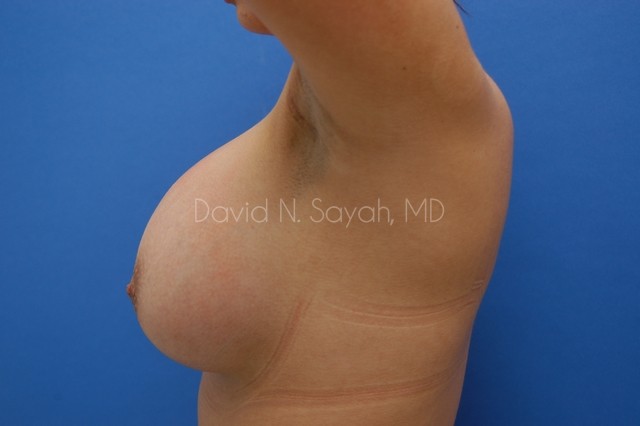 Breast Augmentation Before and After | Sayah Institute