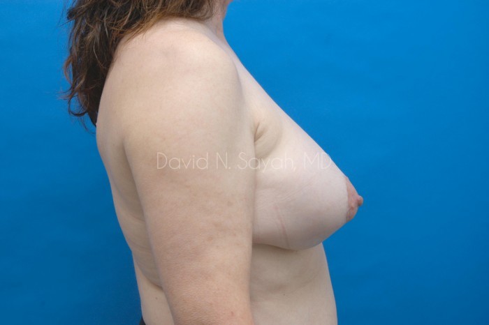 Breast Implant Exchange Before and After | Sayah Institute