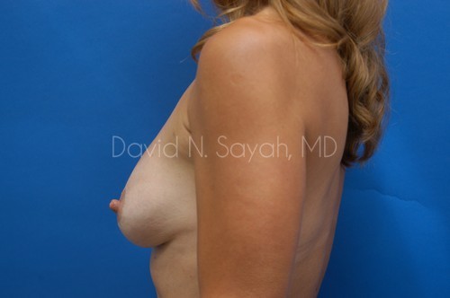 Breast Implant Exchange Before and After | Sayah Institute