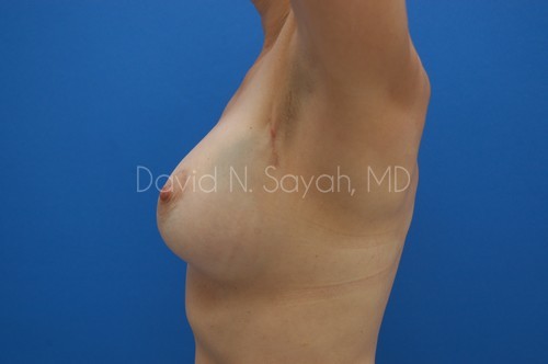 Breast Implant Exchange Before and After | Sayah Institute
