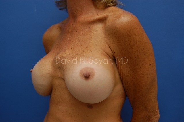 Breast Implant Exchange Before and After | Sayah Institute