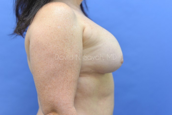 Breast Implant Removal Before and After | Sayah Institute