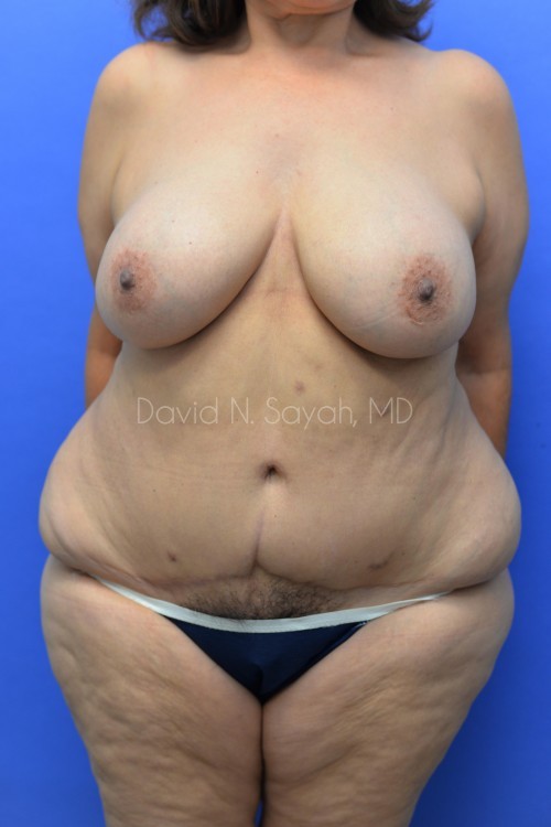 Breast Implant Removal Before and After | Sayah Institute