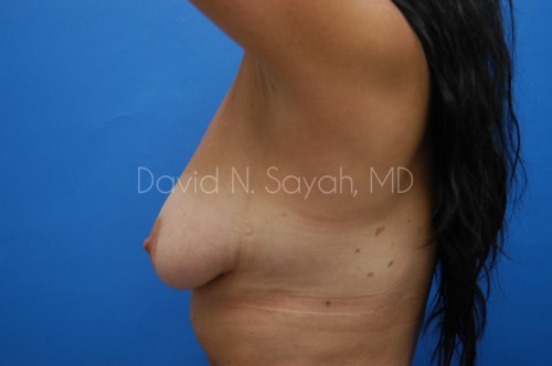 Breast Implant Revision Before and After | Sayah Institute