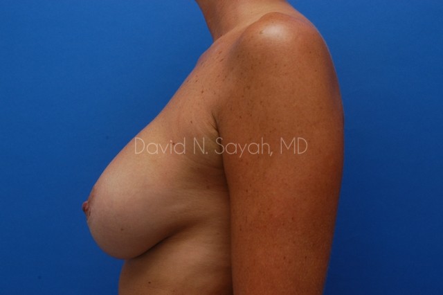 Breast Implant Revision Before and After | Sayah Institute