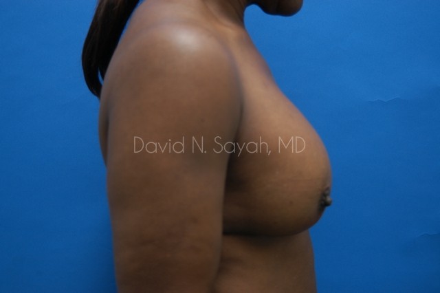 Breast Implant Revision Before and After | Sayah Institute