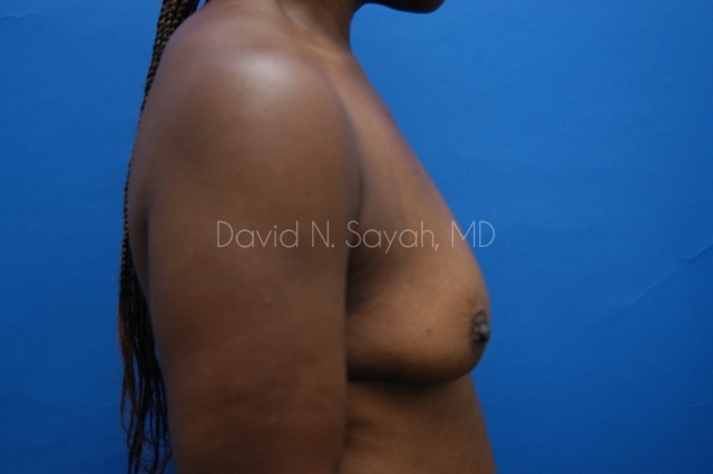 Breast Implant Revision Before and After | Sayah Institute