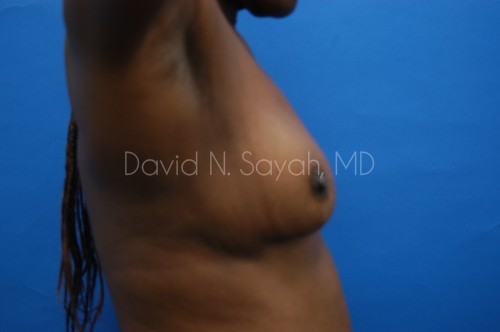 Breast Implant Revision Before and After | Sayah Institute