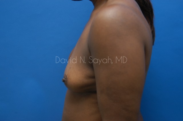 Breast Implant Revision Before and After | Sayah Institute