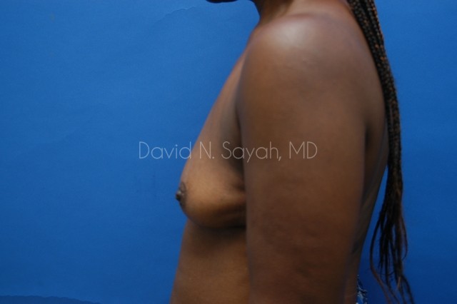 Breast Implant Revision Before and After | Sayah Institute