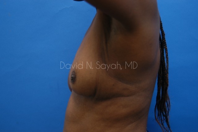 Breast Implant Revision Before and After | Sayah Institute
