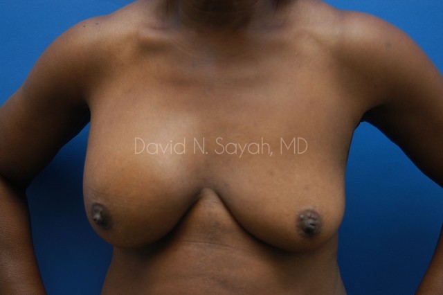 Breast Implant Revision Before and After | Sayah Institute