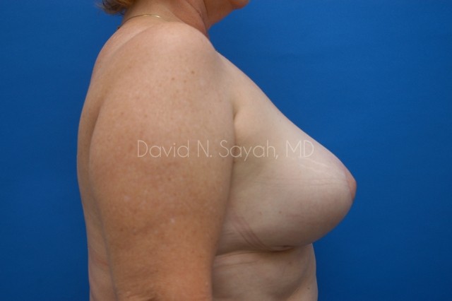 Breast Implant Revision Before and After | Sayah Institute